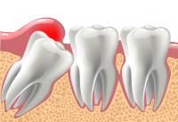 Wisdom Teeth Removal image 1